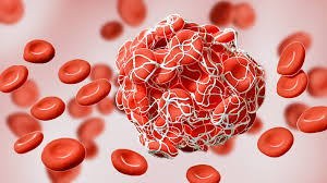 TROMBOSIS: TROMBOFILIA, TROMBOSIS Y CANCER, TROMBOSIS EN SITIOS POCO FRECUENTES, MANEJO DE TVP.