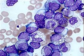 LEUCEMIA MIELOIDE AGUDA